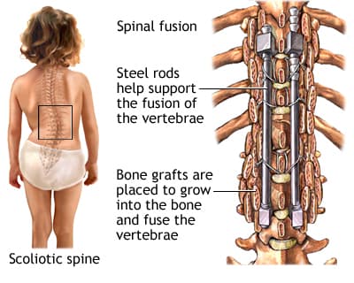 Scoliosis Surgery