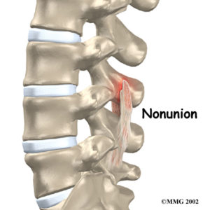 Hudson Valley Scoliosis