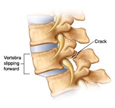 Hudson Valley Scoliosis