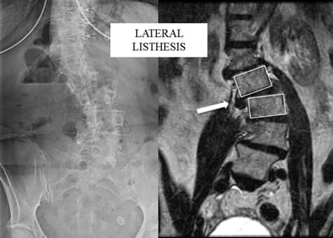 Hudson Valley Scoliosis