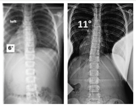 6 degrees curve vs 11 degree scoliosis