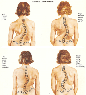 4 appearences of 70 degree scoliosis
