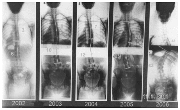 mild scoliosis x ray