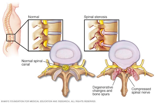 Spinal stenosis