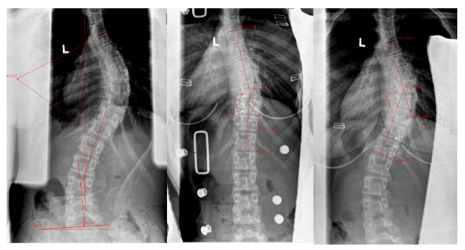brace treatment for scoliosis before and after