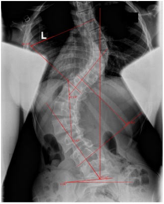 severe scoliosis treatment