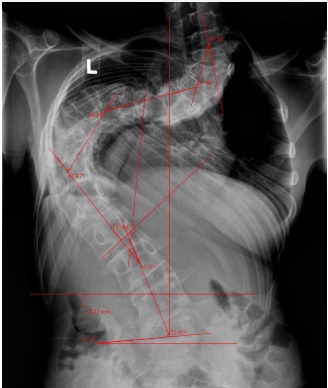 treatment for severe scoliosis