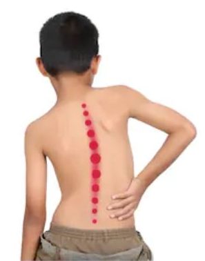 Image result for Information Related To Scoliosis Treatment