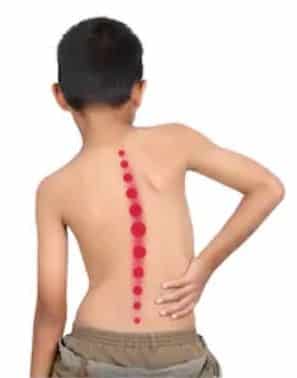 Image result for Information Related To Scoliosis Treatment