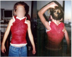 scoliosis treatment for child - cast