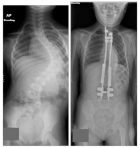 telescoping growth rods juvenile scoliosis