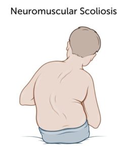 Neuromuscular Scoliosis Treatment
