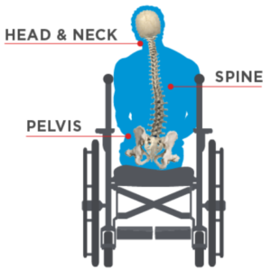 neuromuscular scoliosis and bracing