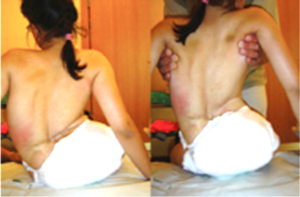 scoliosis bracing for muscular dystrophy cerebral palsy marfans neuromuscualr scoliosis