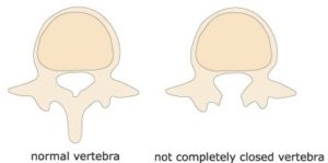 spina bifida scoliosis brace