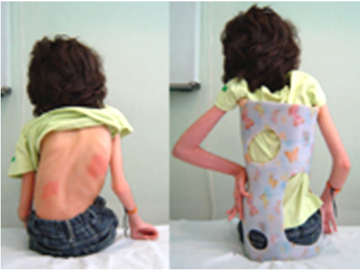 https://www.hudsonvalleyscoliosis.com/wp-content/uploads/2019/11/suspension-scoliosis-brace-for-patients-in-wheelchair.png