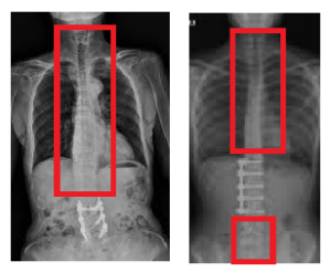 unfused areas of the spine