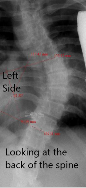 upper right thoracic scoliosis