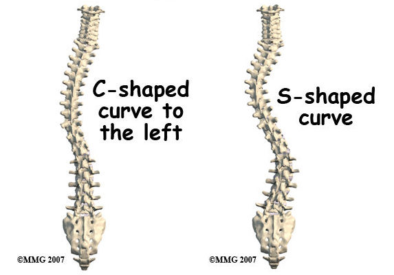 c and s shaped scoliosis curves